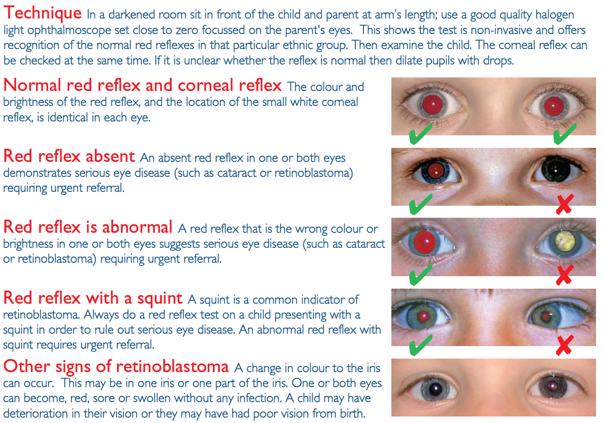 Artificial eyes  Childhood Eye Cancer Trust