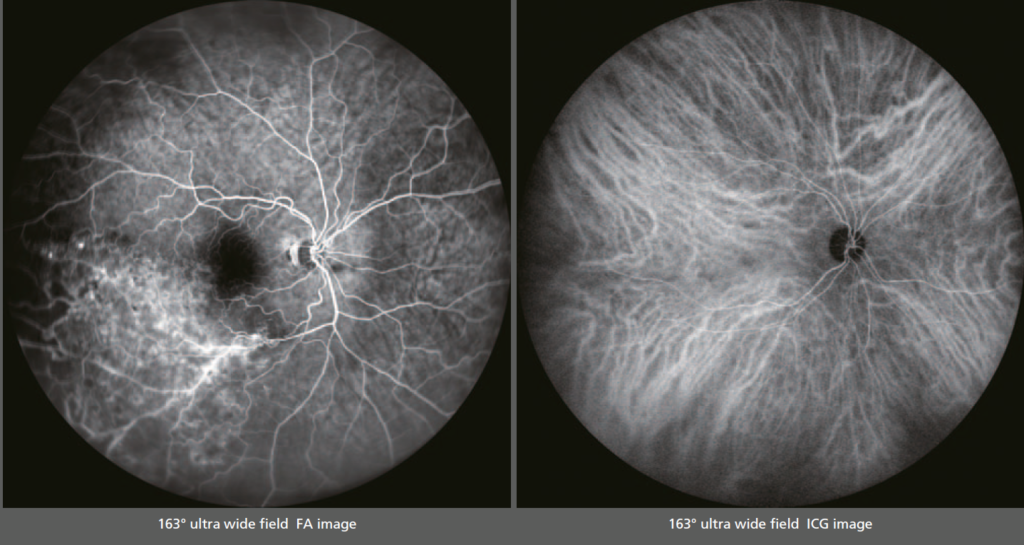 163° ultra wide field FA and ICG images