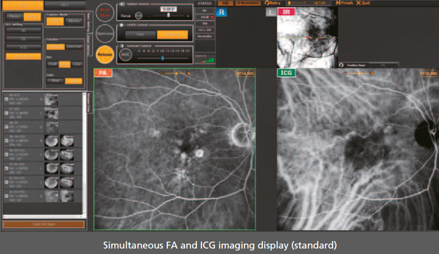 Simultaneous FA and ICG imaging display (standard) Easy comparison of FA and ICG The viewer software can present FA and ICG images side-by-side. Easy comparison is helpful for comprehensive evaluation. Live