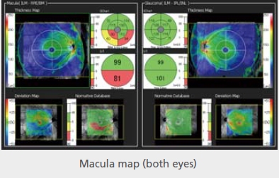 Glaucoma analysis 1