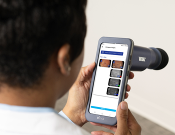 Volk Viva non-mydriatic imaging